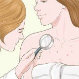 Sbarazzati delle cicatrici da acne sul petto