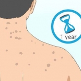 Sbarazzati delle cicatrici da acne sulla schiena