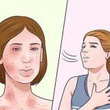 Trattare le allergie