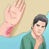 Prevenire il botulismo