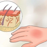 Trattamento delle ustioni da acqua calda