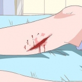 Trattare la cellulite
