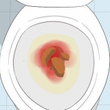 Riconoscere i sintomi del cancro al colon