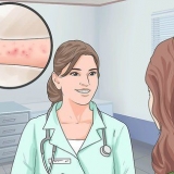 Alleviare i sintomi della dermatite spongiotica