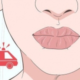 Guarisci un'ustione sulle tue labbra