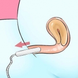 Rimuovere un tampone