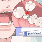 Riparazione di una corona dentale perduta