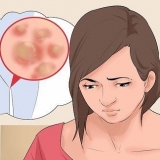 Trattamento delle verruche genitali nelle donne