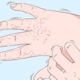 Trattamento dell'eczema alle mani