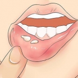Riconoscere l'herpes