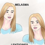 Trattamento dell'iperpigmentazione