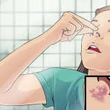 Trattare l'herpes labiale nel naso