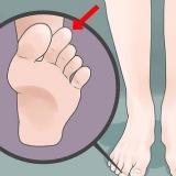 Affrontare il piede greco (sindrome di morton)