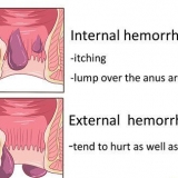 Come sbarazzarsi delle emorroidi in modo naturale