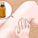 Trattare la tigna: può farlo naturalmente?