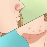 Sbarazzati dell'acne in modo rapido e naturale