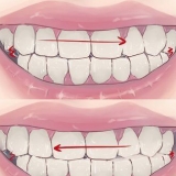 Smetti di digrignare i denti nel sonno