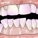 Rimuovere la placca dentale