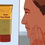 Sbarazzati di un brufolo con il gel di aloe vera