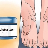 Trattare l'eczema invernale