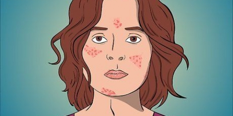 Rimedio dell'acne con formazione di cisti