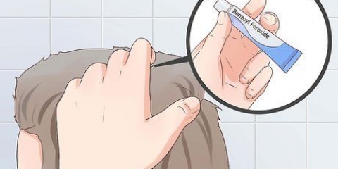 Tratta l'acne sul cuoio capelluto