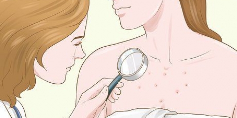 Sbarazzati delle cicatrici da acne sul petto
