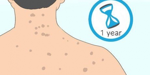 Sbarazzati delle cicatrici da acne sulla schiena