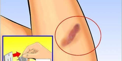 Usando l'aloe vera per curare le ustioni
