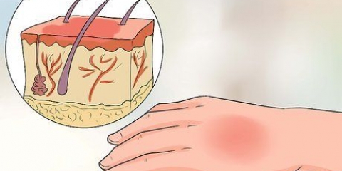 Trattamento delle ustioni da acqua calda
