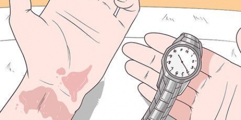 Trattare le ustioni da aceto di mele