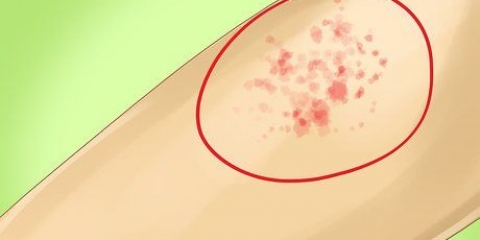 Riconoscere il morbillo