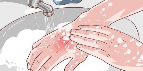 Trattare una bruciatura di sigaretta
