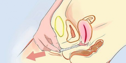 Rimuovere un preservativo sloggiato dal tuo corpo