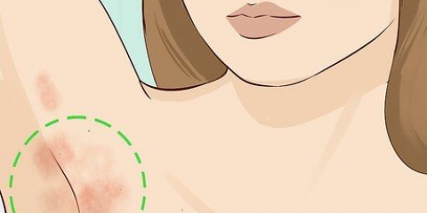 Trattare un'infezione fungina della pelle