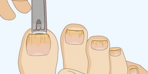 Cura un'unghia fungina: si può fare con l'aceto?