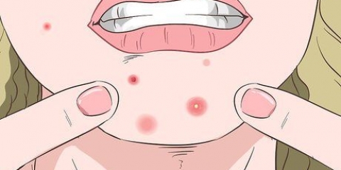 Riconoscere un'infezione da stafilococco