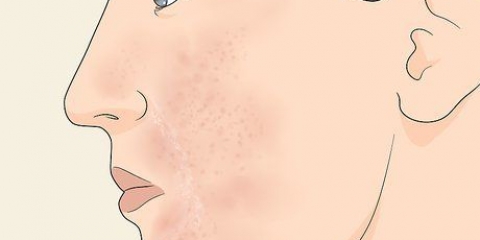 Cura la pelle troppo esfoliata