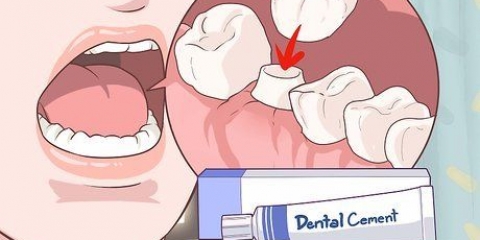Riparazione di una corona dentale perduta