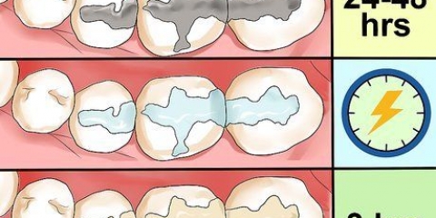 Prendersi cura di un'otturazione in un dente o molare