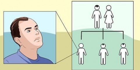 Trattare la caduta dei capelli negli uomini