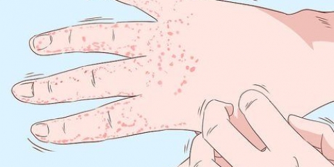 Trattamento dell'eczema alle mani