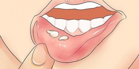 Riconoscere l'herpes
