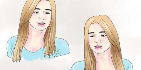 Trattamento dell'iperpigmentazione