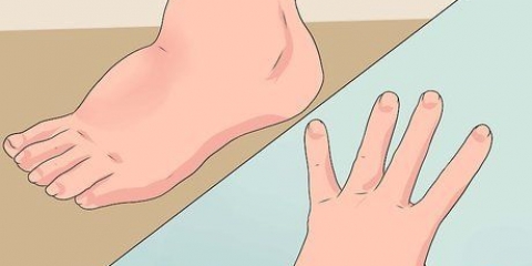 Sbarazzati dell'edema in modo naturale