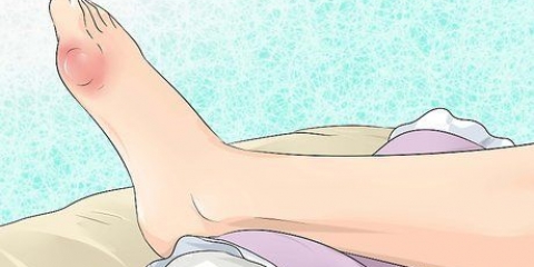 Alleviare il dolore della gotta a casa