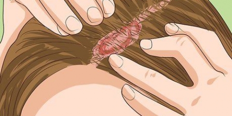 Riconoscere la psoriasi del cuoio capelluto