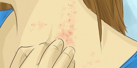 Trattare le infezioni fungine della pelle: può farlo naturalmente?