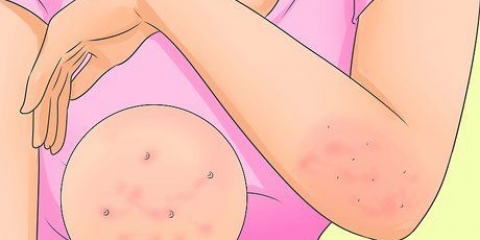 Trattare la scabbia