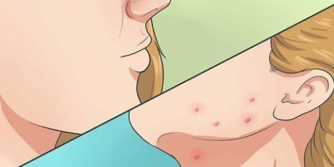 Sbarazzati dell'acne in modo rapido e naturale